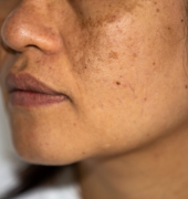 Hyperpigmentation