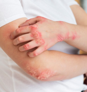 Psoriasis